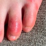 Immune System Overreaction May Cause ‘Covid Toes,’ Study Says