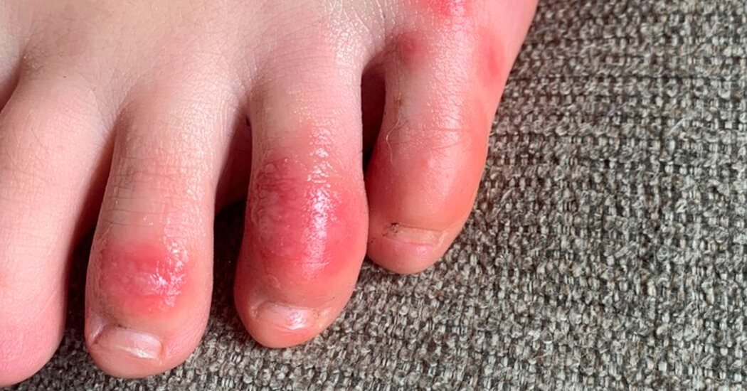 Immune System Overreaction May Cause ‘Covid Toes,’ Study Says